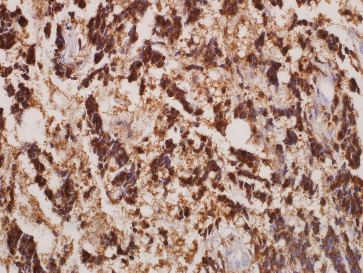 IHC lysozyme - maxillary biopsy